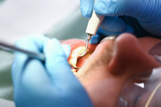Best Emergency Treatment for Dental Infections or Abscesses in Bay Pines, FL