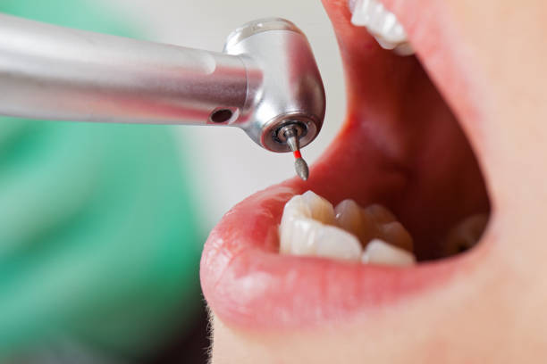Best Emergency Treatment for Dental Infections or Abscesses in Bay Pines, FL
